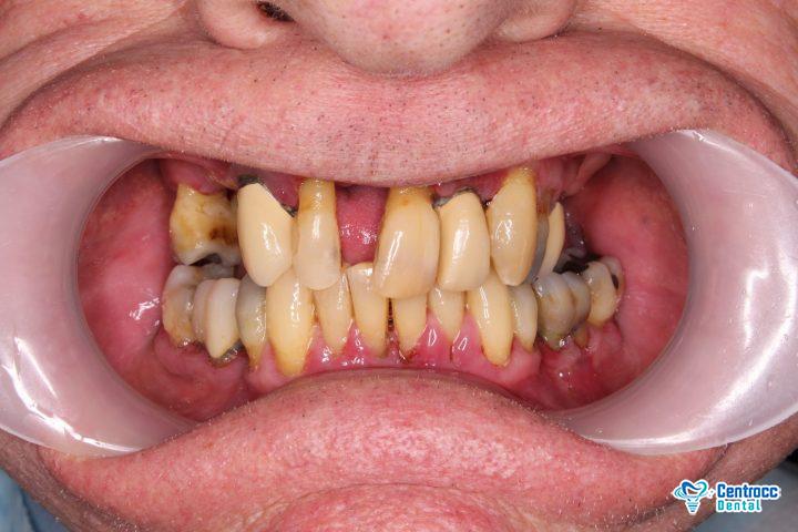 Gingivitis oder Zahnfleischentzündung