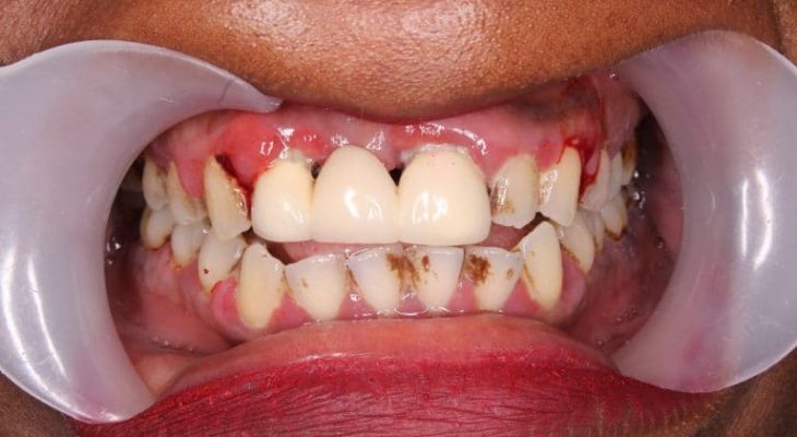 Loch Im Zahn Behandlung Ohne Schmerzen Centrocc Dental Loch Im Zahn Behandlung Ohne Schmerzen Centrocc Dental