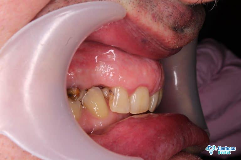 Zahnfleischentzündung und Loch im Zahn