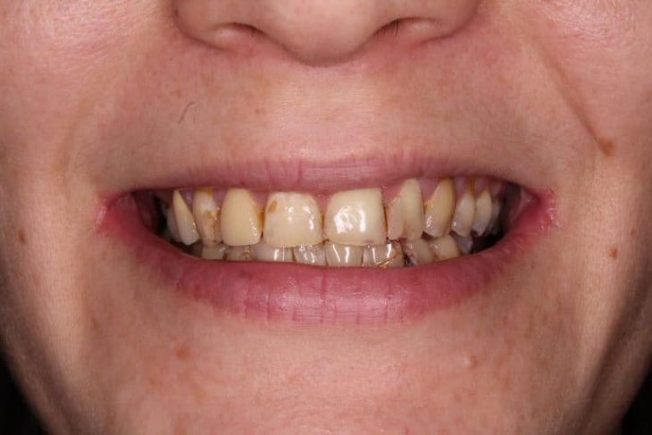 Loch im Zahn: Behandlung ohne Schmerzen? | Centrocc Dental