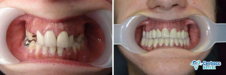 vorher-nachher Zahnimplantat