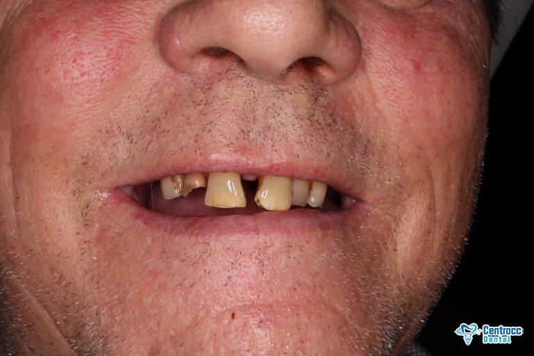 Parodontitis Wie man erkennt und heilt? Centrocc Dental