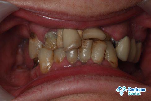 Zanhfleischbluten Zahnfleischentzündung