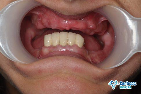 Fehlende Zähne, Parodontitis